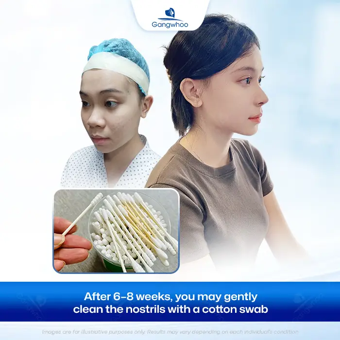 How Long After Rhinoplasty Can You Pick Your Nose? Safe Cleaning Guidelines