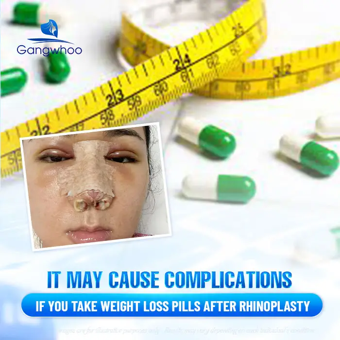 How Long After Rhinoplasty Can You Take Weight Loss Medication? A Doctor’s Explanation