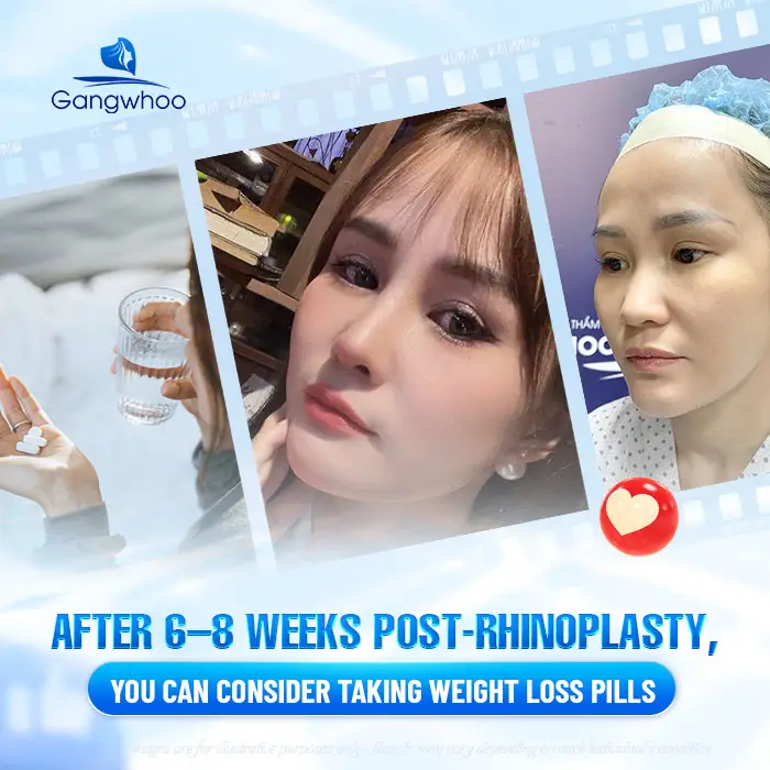 How Long After Rhinoplasty Can You Take Weight Loss Medication? A Doctor’s Explanation