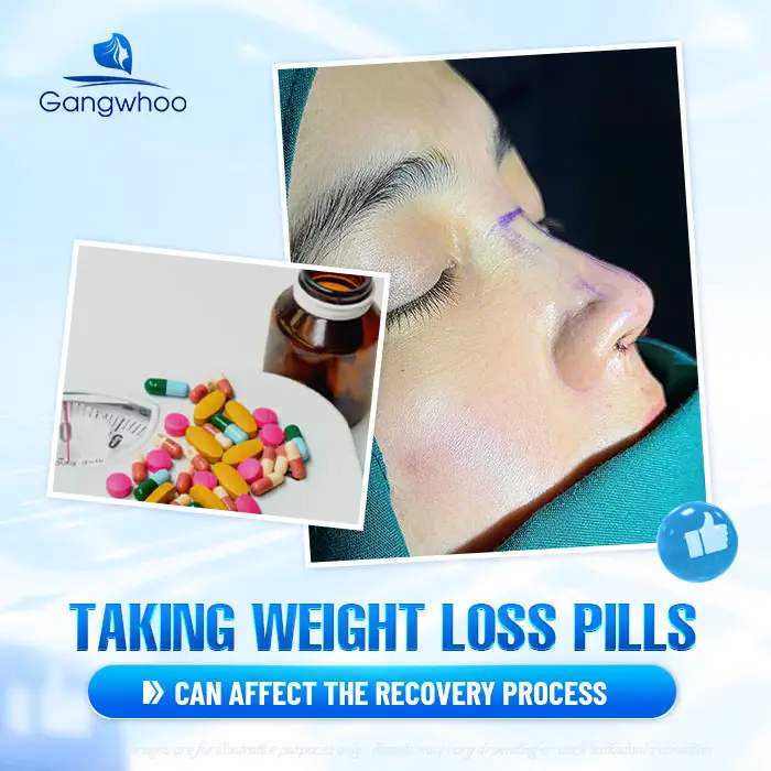 How Long After Rhinoplasty Can You Take Weight Loss Medication? A Doctor’s Explanation