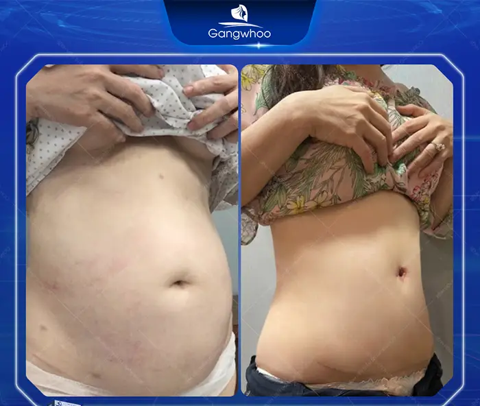 Tummy Tuck Surgery: How Much Does It Cost? Updated 2025 Price List