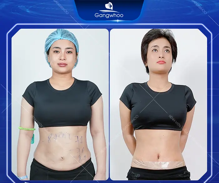 Tummy Tuck Surgery: How Much Does It Cost? Updated 2025 Price List