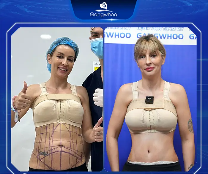 Tummy Tuck Surgery: How Much Does It Cost? Updated 2025 Price List