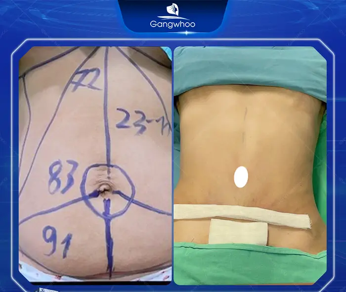 Tummy Tuck Surgery: How Much Does It Cost? Updated 2025 Price List
