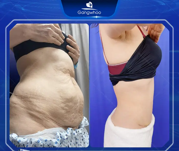 Tummy Tuck Surgery: How Much Does It Cost? Updated 2025 Price List