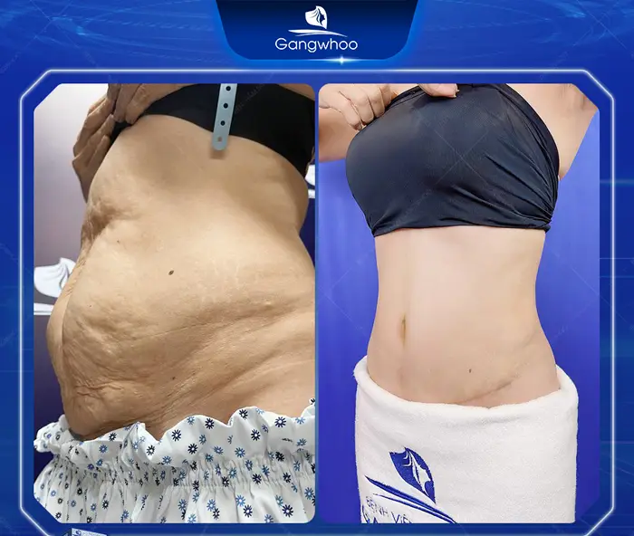 Tummy Tuck Surgery: How Much Does It Cost? Updated 2025 Price List