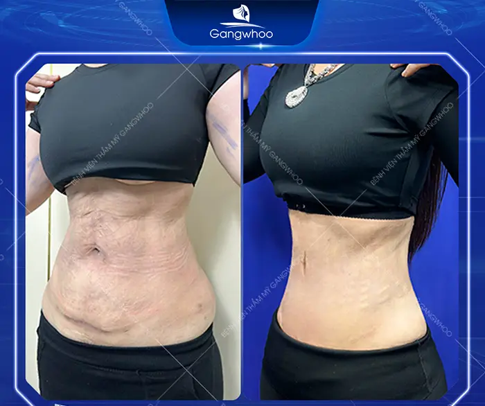 Tummy Tuck Surgery: How Much Does It Cost? Updated 2025 Price List