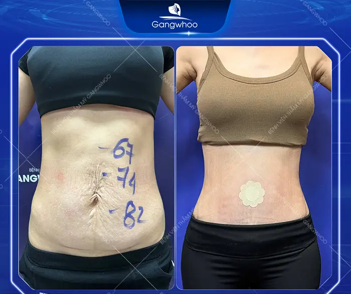 Tummy Tuck Surgery: How Much Does It Cost? Updated 2025 Price List