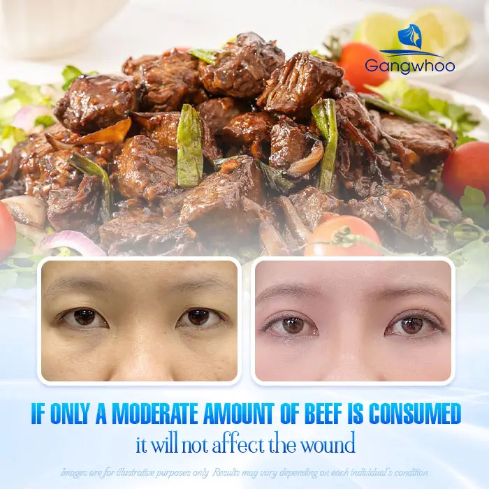 How Long Should You Avoid Eating Beef After Eyelid Surgery? Doctor’s ...
