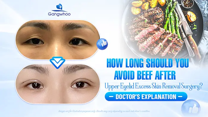 How Long Should You Avoid Eating Beef After Eyelid Surgery? Doctor’s Explanation