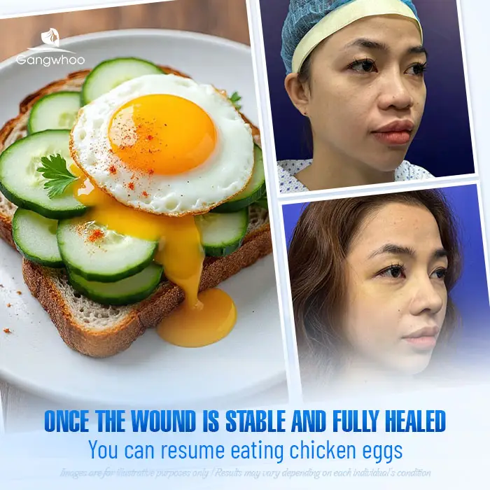How Long After Rhinoplasty Can You Eat Eggs? Important Considerations
