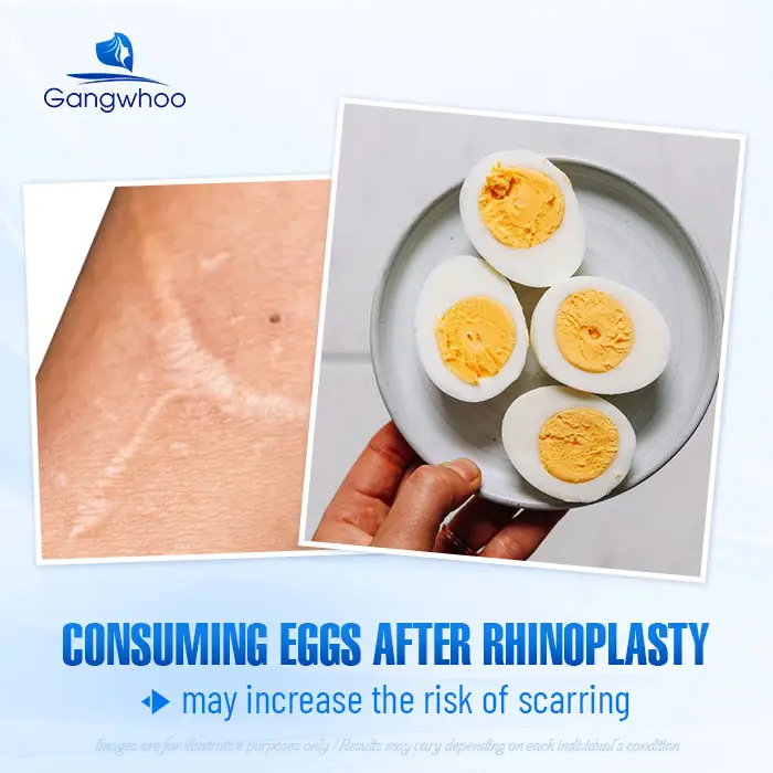 How Long After Rhinoplasty Can You Eat Eggs? Important Considerations