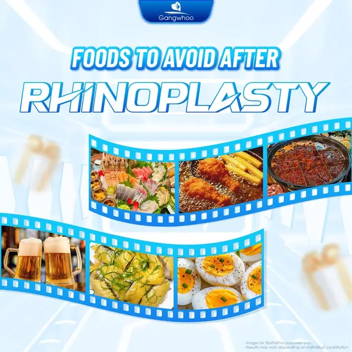 How Long After Rhinoplasty Can You Eat Sticky Rice? Doctor Explains