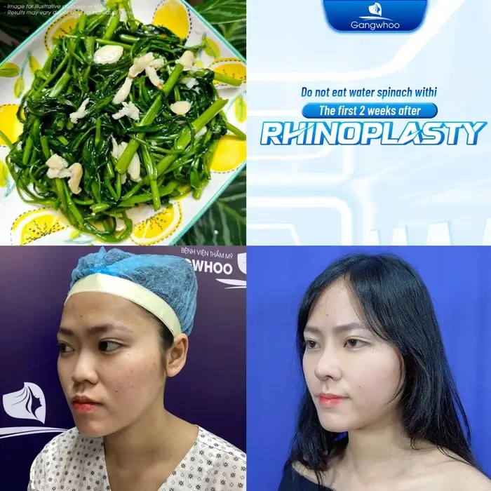 How Long After a Nose Job Can You Eat Water Spinach? Doctor’s Advice
