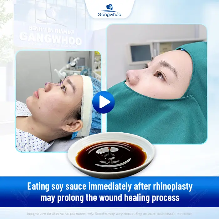 How Long After Rhinoplasty Can You Eat Soy Sauce? Why Should Soy Sauce Be Avoided?