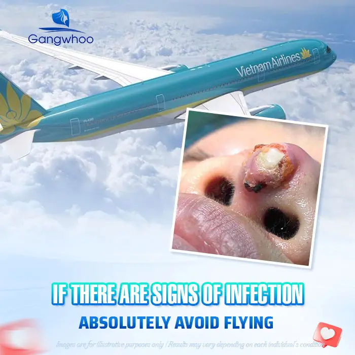 How Long After a Nose Job Can You Fly? Domestic & International Flight Guidelines