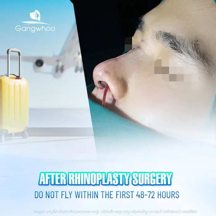 How Long After a Nose Job Can You Fly? Domestic & International Flight Guidelines