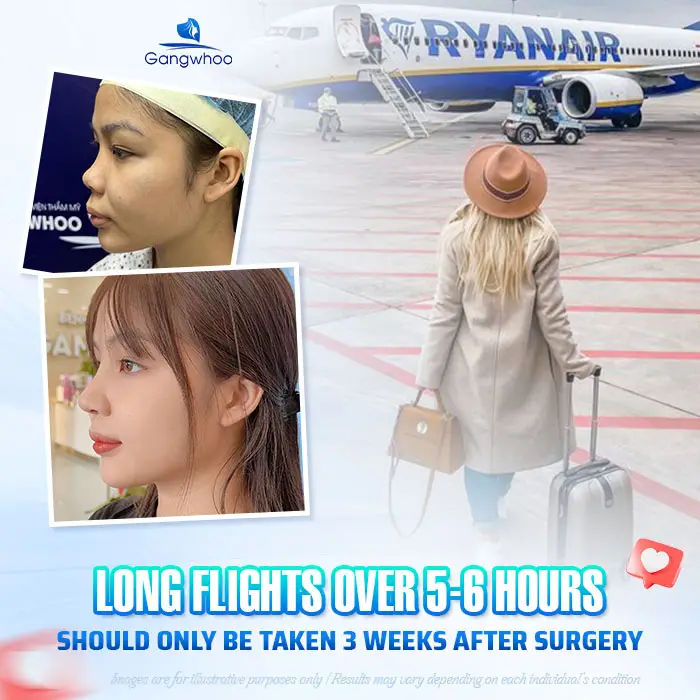 How Long After a Nose Job Can You Fly? Domestic & International Flight Guidelines