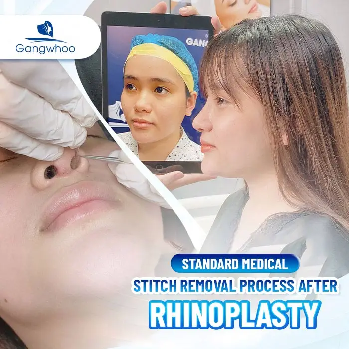 How Many Days After Rhinoplasty Can the Stitches Be Removed? Is It Dangerous to Remove Them Early?