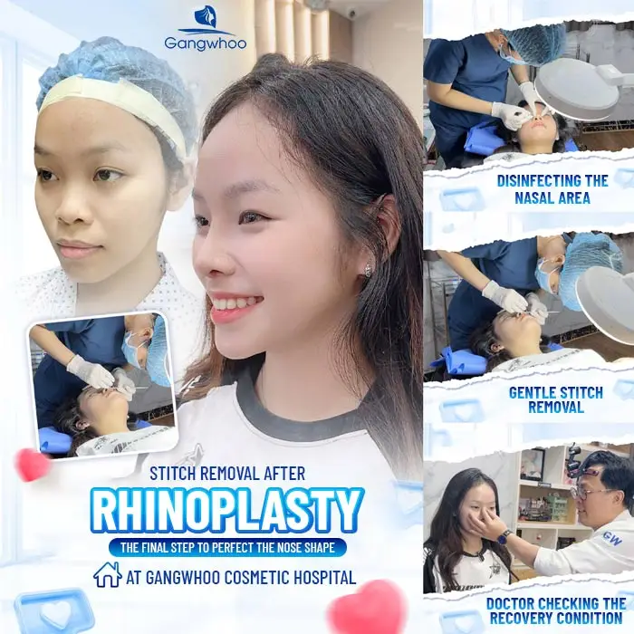 How Many Days After Rhinoplasty Can the Stitches Be Removed? Is It Dangerous to Remove Them Early?