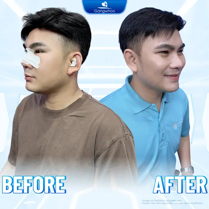 How Many Days After Rhinoplasty Can the Stitches Be Removed? Is It Dangerous to Remove Them Early?