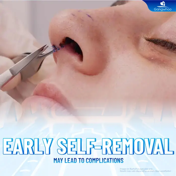 How Many Days After Rhinoplasty Can the Stitches Be Removed? Is It Dangerous to Remove Them Early?