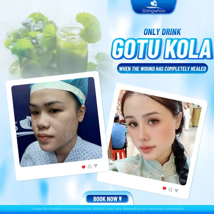 Can You Drink Gotu Kola After Rhinoplasty? Benefits and Risks