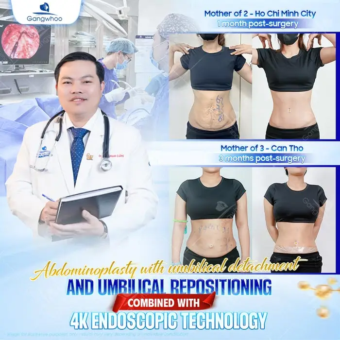 Tummy Tuck Surgery: How Much Does It Cost? Updated 2025 Price List