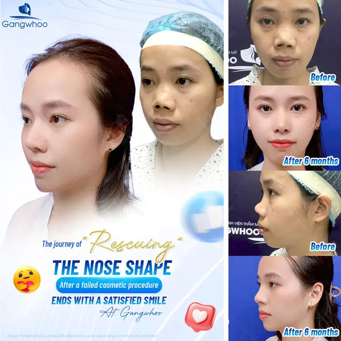 How Much Does Nose Revision Surgery Cost? 2025 Nose Revision Price Guide
