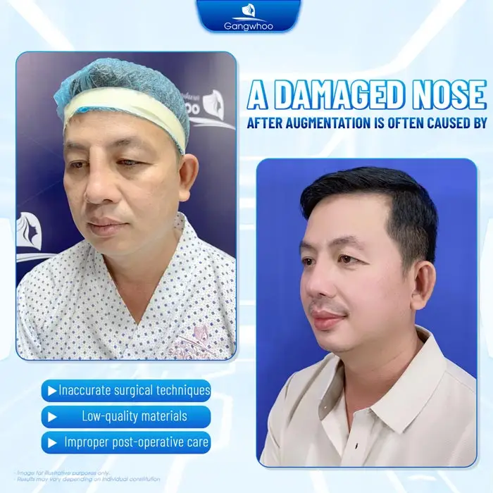 How Much Does Nose Revision Surgery Cost? 2025 Nose Revision Price Guide
