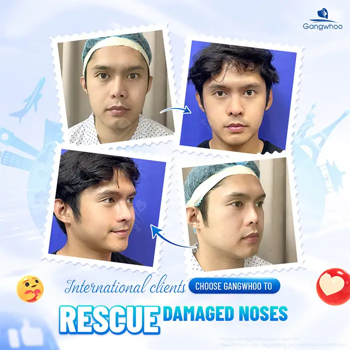 How Much Does Nose Revision Surgery Cost? 2025 Nose Revision Price Guide