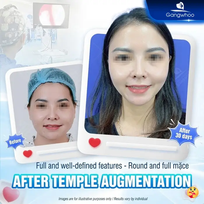 Misaligned Temple Augmentation – Causes, Signs, and Treatment Options