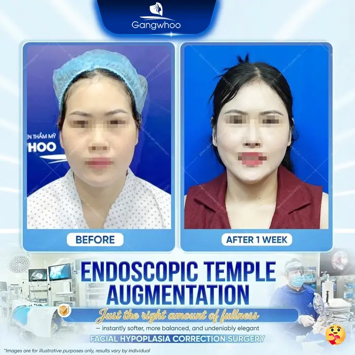 Misaligned Temple Augmentation – Causes, Signs, and Treatment Options