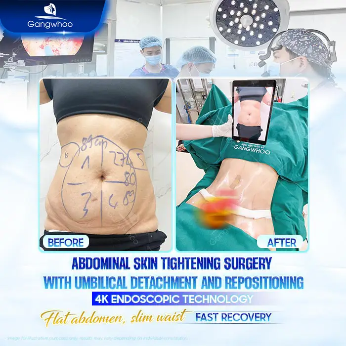 Top 6 Highly Skilled Tummy Tuck Surgeons in Ho Chi Minh City