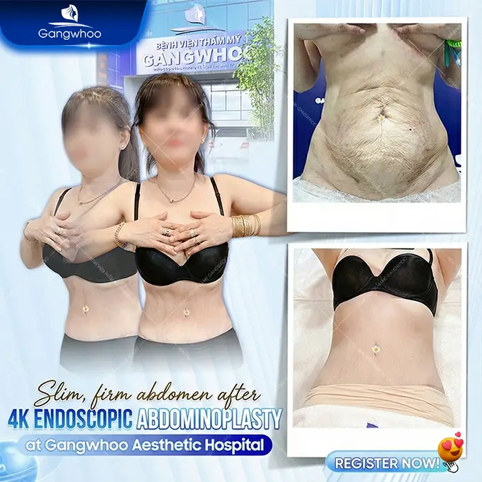 Top 6 Highly Skilled Tummy Tuck Surgeons in Ho Chi Minh City