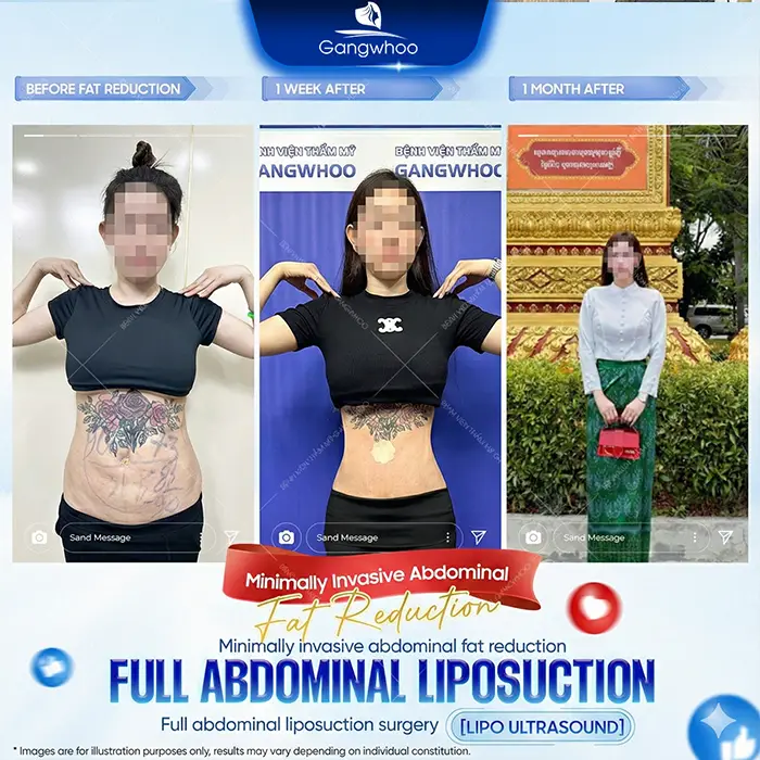 Top 10 Highly Reputable and Skilled Belly-Fat Liposuction Doctors in Ho Chi Minh City