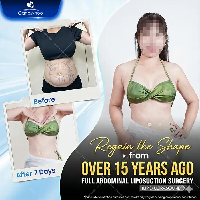 Top 10 Highly Reputable and Skilled Belly-Fat Liposuction Doctors in Ho Chi Minh City