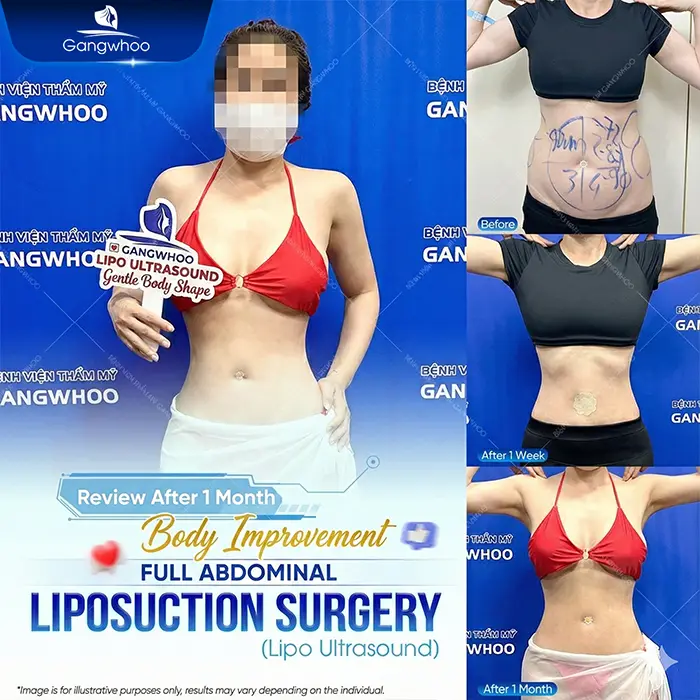 Top 10 Highly Reputable and Skilled Belly-Fat Liposuction Doctors in Ho Chi Minh City