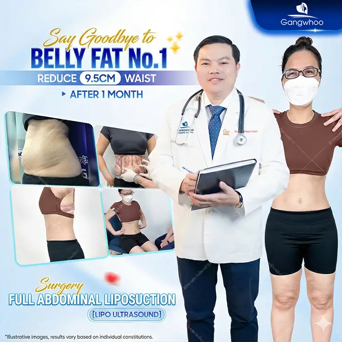 Top 10 Highly Reputable and Skilled Belly-Fat Liposuction Doctors in Ho Chi Minh City
