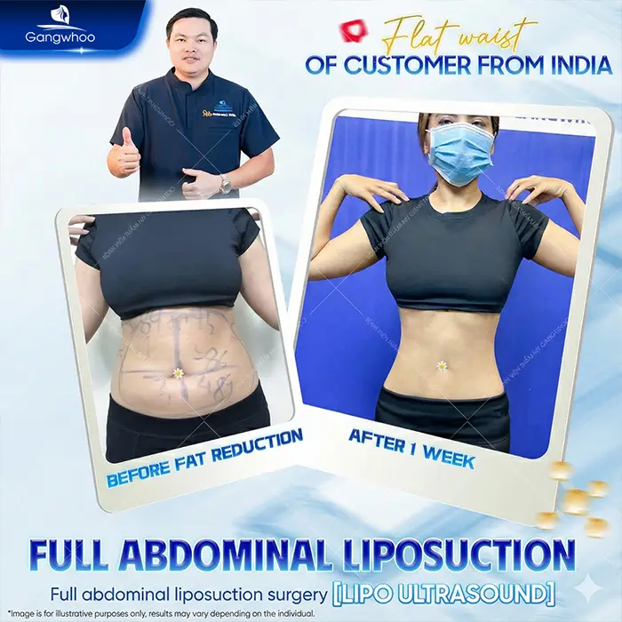 Top 10 Highly Reputable and Skilled Belly-Fat Liposuction Doctors in Ho Chi Minh City