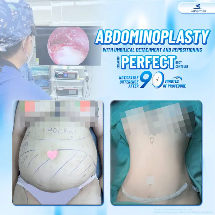 Abdominoplasty Recovery Time: Doctor’s Complete Post-Operative Care Guide