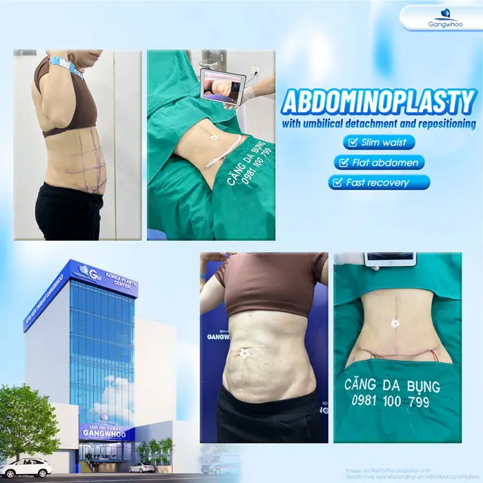 Abdominoplasty Recovery Time: Doctor’s Complete Post-Operative Care Guide