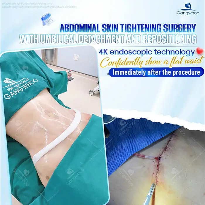 Abdominoplasty Recovery Time: Doctor’s Complete Post-Operative Care Guide