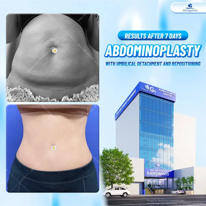 How Long Does It Take to Recover from a Tummy Tuck? Proper Aftercare Guide