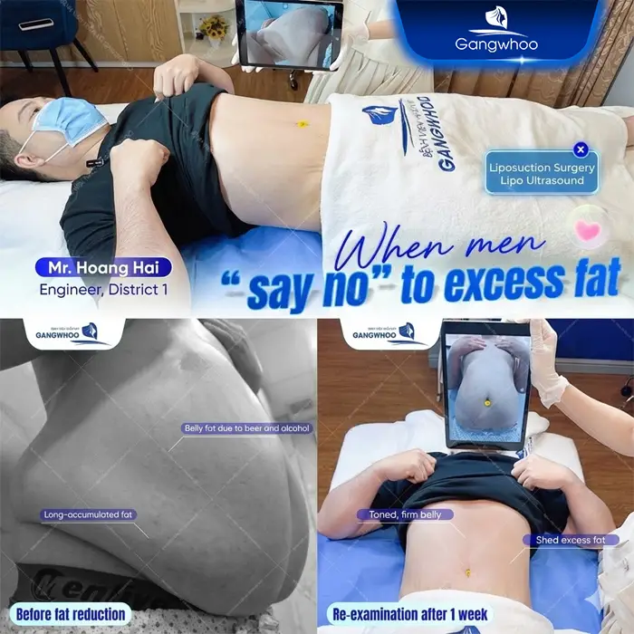 Does a Tummy Tuck Hurt? Effective Ways to Reduce Pain