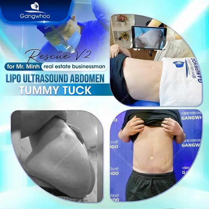 Does a Tummy Tuck Hurt? Effective Ways to Reduce Pain