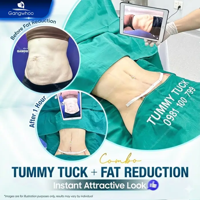 Does a Tummy Tuck Hurt? Effective Ways to Reduce Pain