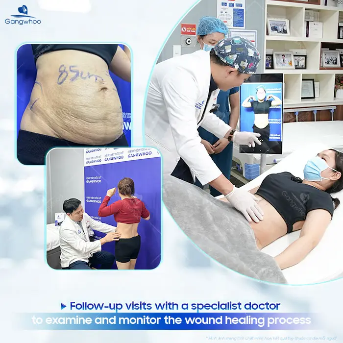Doctor’s Guide To Tummy Tuck Care – Medically Standardized Instructions