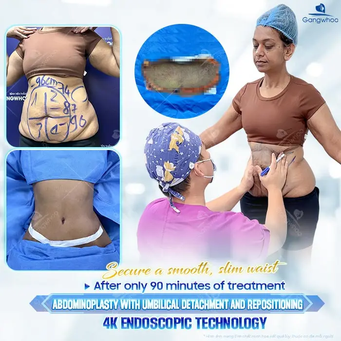 Doctor’s Guide To Tummy Tuck Care – Medically Standardized Instructions