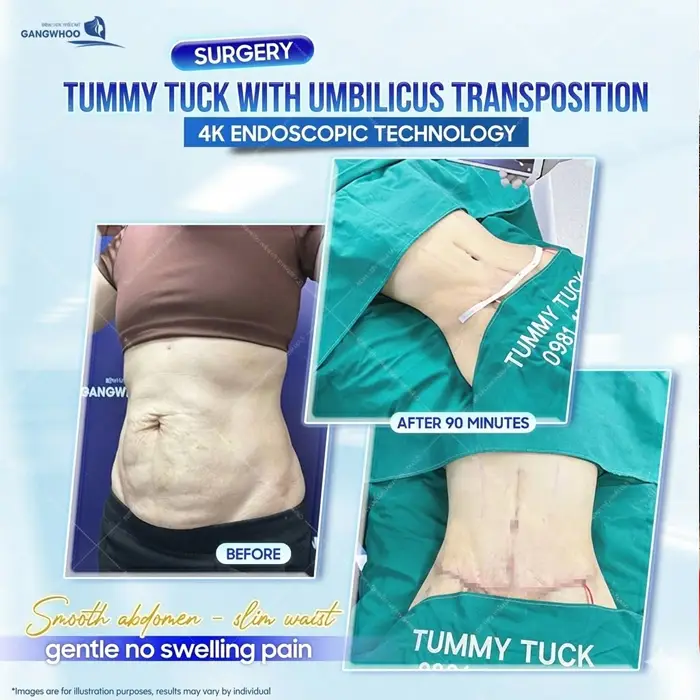 Doctor’s Guide To Tummy Tuck Care – Medically Standardized Instructions